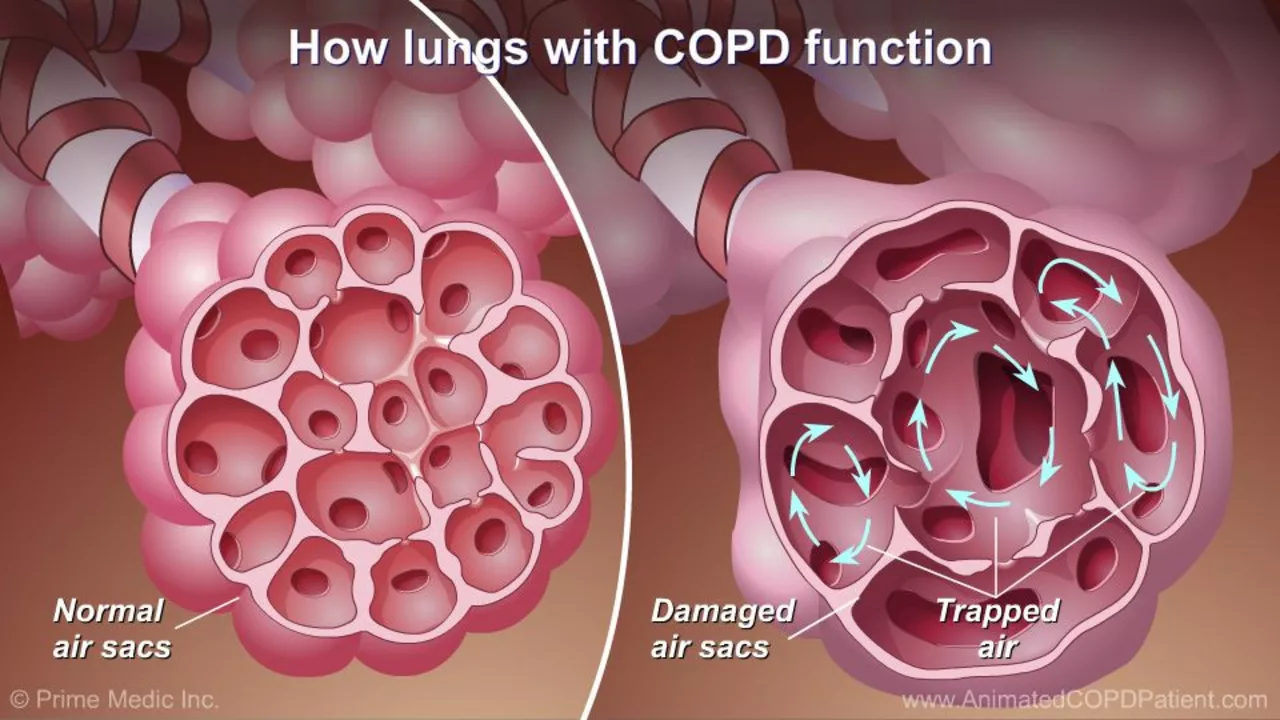 The Impact of Cold Weather on Chronic Obstructive Pulmonary Disease Symptoms