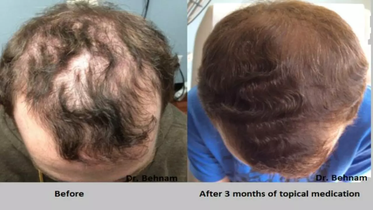 Minoxidil Topical for Seniors: Addressing Age-Related Hair Loss